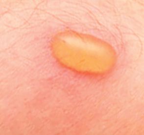 Blister Beetle Bites