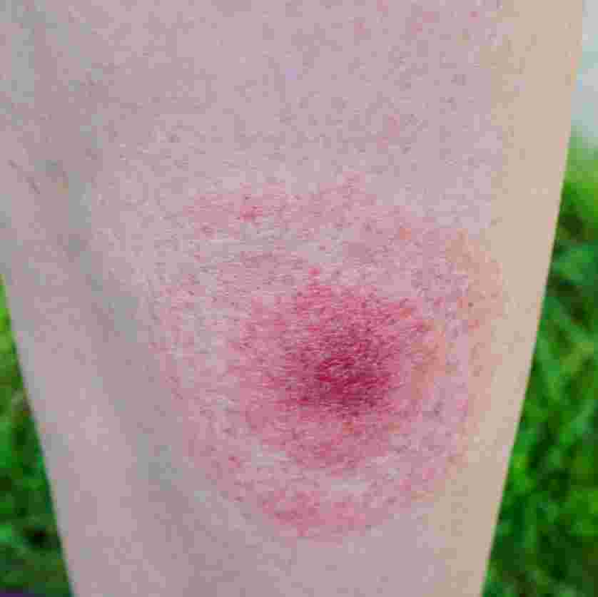 Tick Bites bug bite