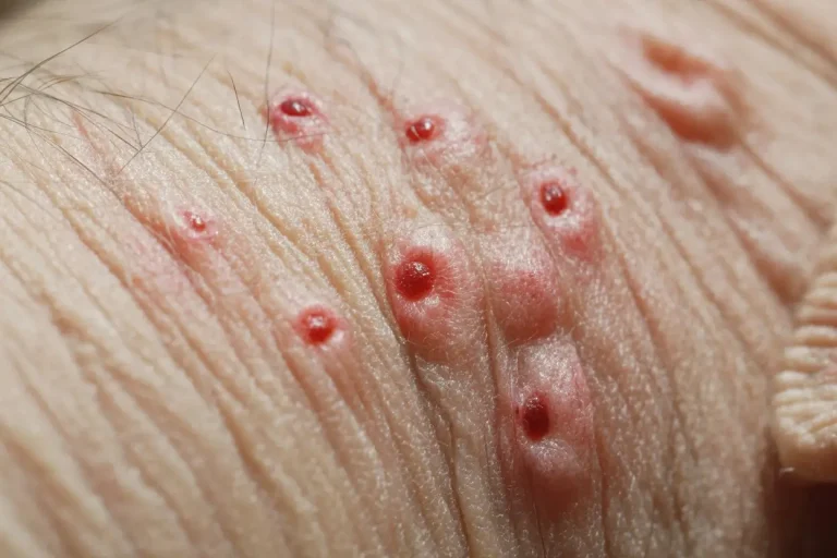 Bed Bug Bites