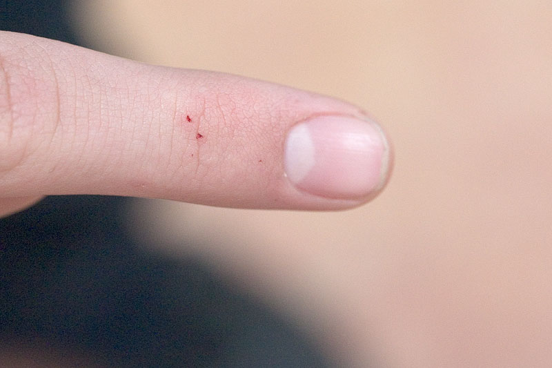 Black Widow Spider Bites