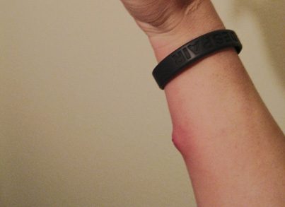 Pain and swelling after a suspected spider bite.