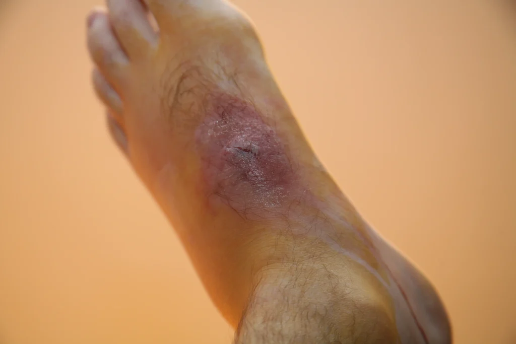 What Does a Spider Bite Look Like
