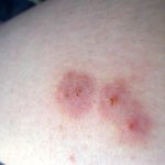 What Does a Spider Bite Look Like