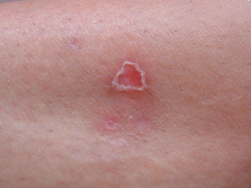 What Does a Spider Bite Look Like
