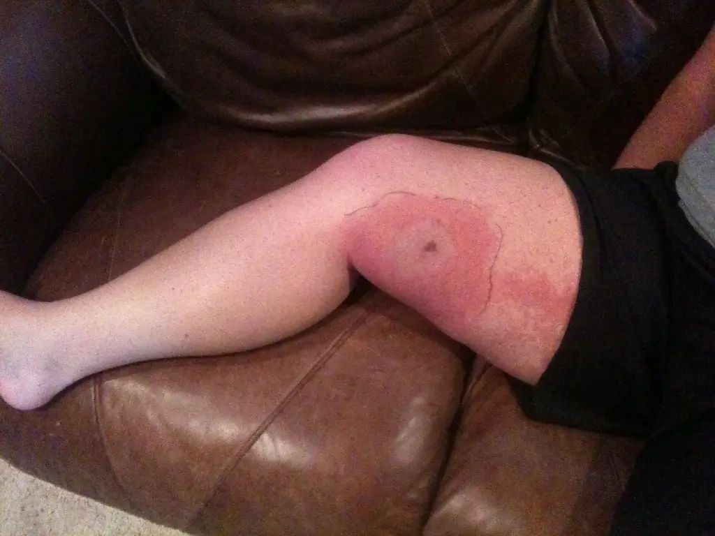 Spider bite causing pain, swelling, and irritation.
