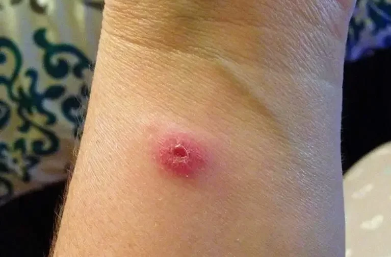 What Does a Spider Bite Look Like
