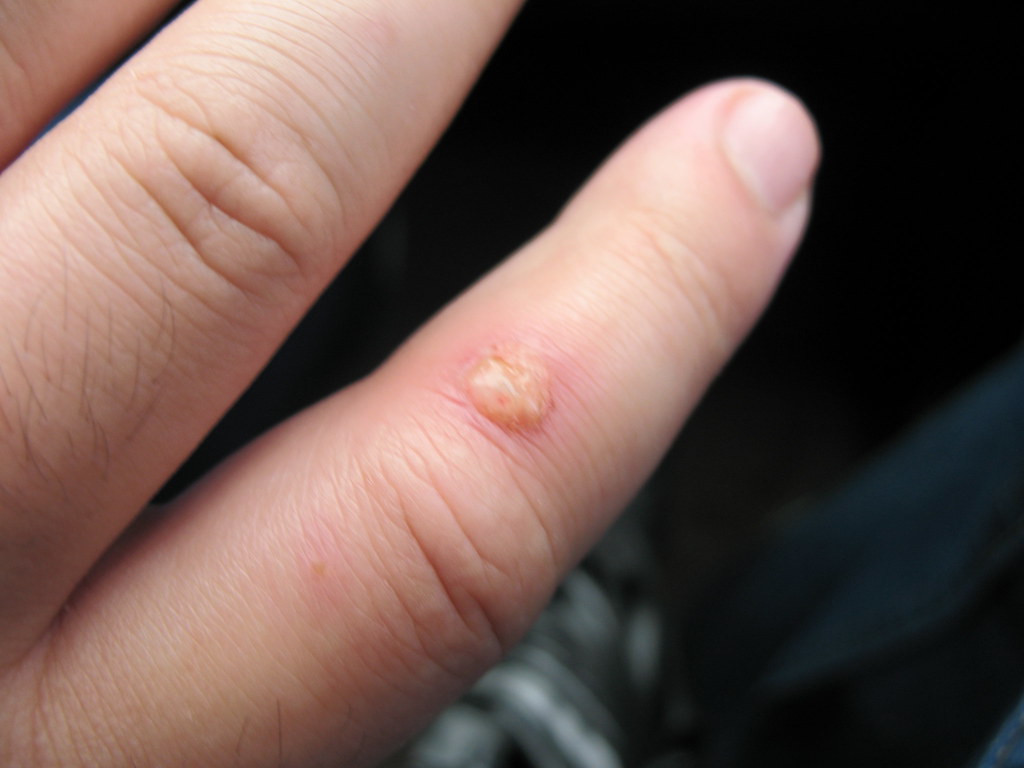 What Does a Spider Bite Look Like