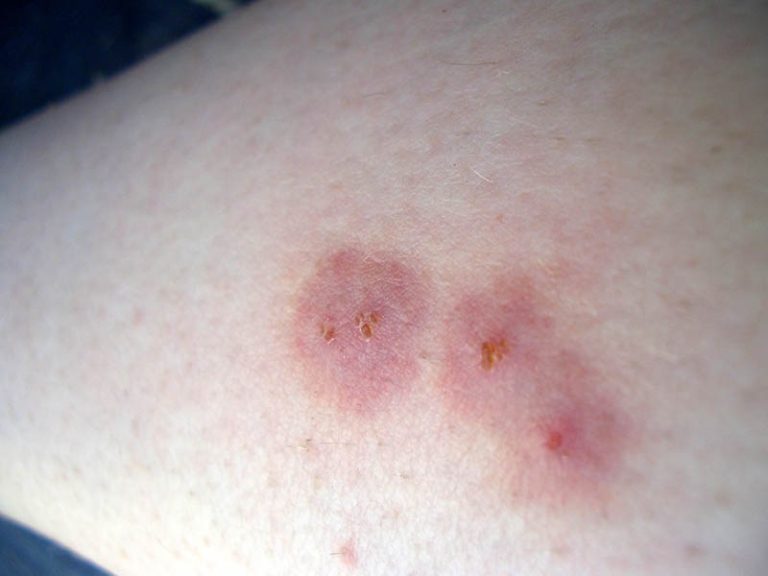 What Does a Spider Bite Look Like