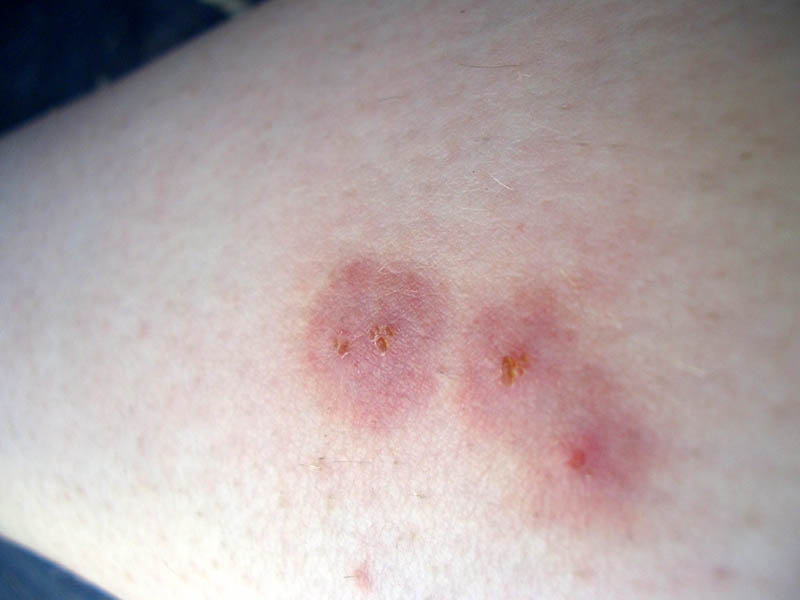 What Does a Spider Bite Look Like