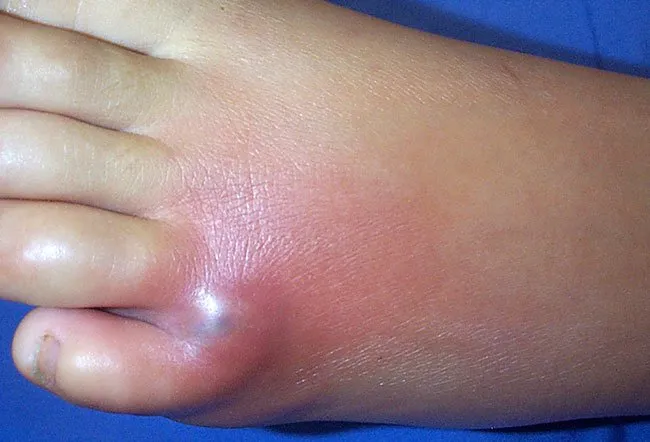 Brown Recluse Spider Bite